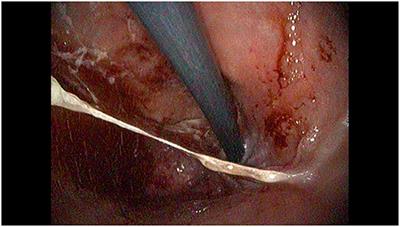 Case Report: Refractory Autoimmune Gastritis Responsive to Abatacept in LRBA Deficiency